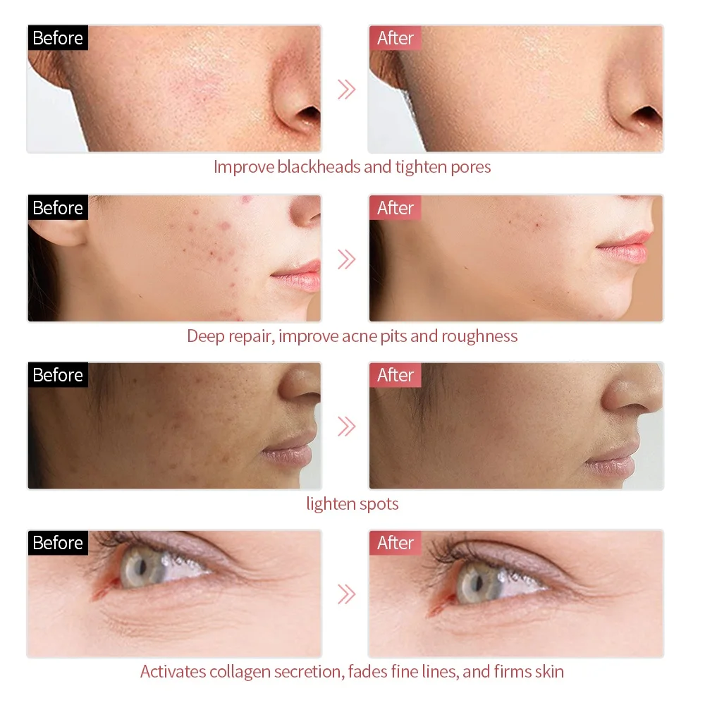 Foreverlily 7 Colors Light LED Facial Skin Care Mask Neck Skin Rejuvenation Treatment Beauty Anti Acne Therapy Whitening